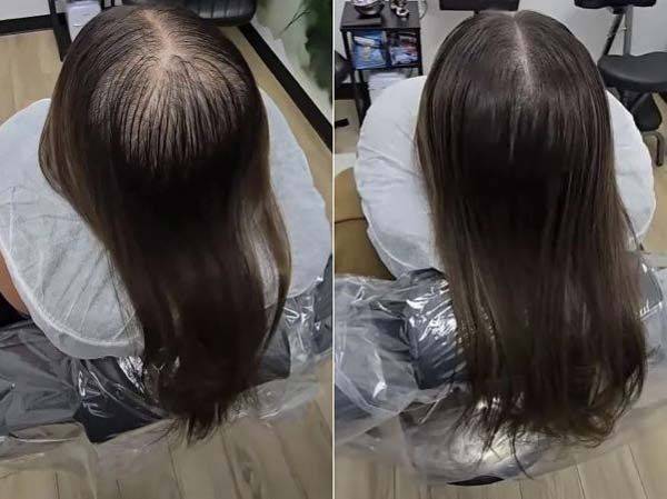 탈모로 고민하던 한 미국 여성의 정수리가 두피 문신 시술 후 촘촘하게 채워진 모습이 공개됐다. 사진은 두피 문신 전(왼)과 후(오) /사진=더 선