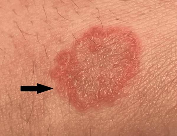 73세 남성에게 C형 간염 바이러스 감염으로 인해 발생한 동전 모양 습진./사진=큐레우스