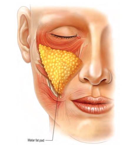 중요한 것은 삼각형의 광대 볼살(malar fat pad)이다. 이 볼살은 웃을 때 입꼬리를 끌어올리는 광대근(zygomaticus major muscle)위에 붙어 있다. [그림=Plast. Reconstr. Surg. 128: 747e, 2011.]