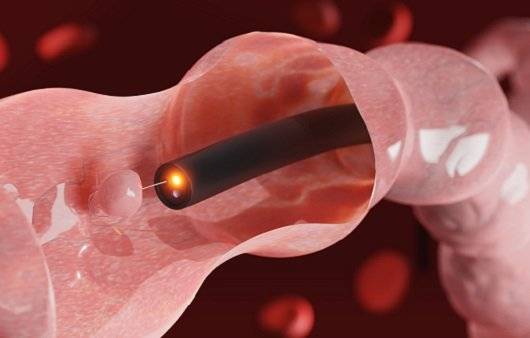 대장내시경｜출처: 게티이미지 뱅크