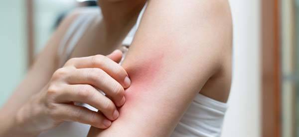 모기나 진드기에게 물렸을 때, 상황에 따라 올바르게 대처하면 증상을 줄일 수 있다./사진=게티이미지뱅크