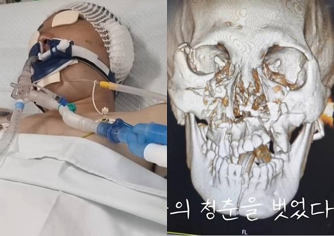 자주포 포신에 깔려 턱뼈가 부러지는 등 심각한 상해를 입은 병사가 현역 복무 부적합 심사(현부심)를 통과하지 못했다.  /사진=안태랑씨 유튜브 채널 캡처