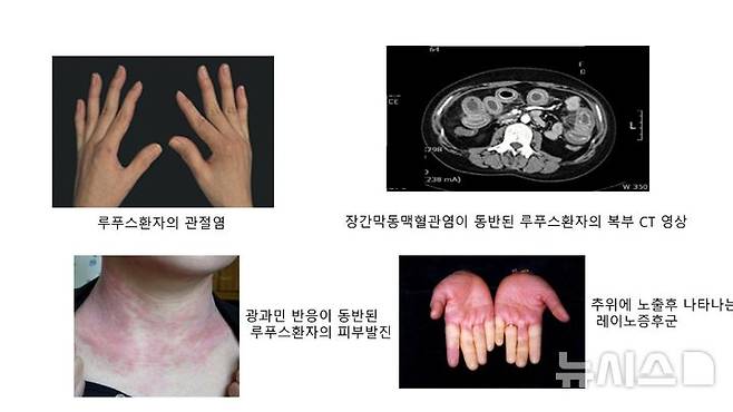 [서울=뉴시스] 루푸스 사진. (사진= 가톨릭대학교 서울성모병원 제공)