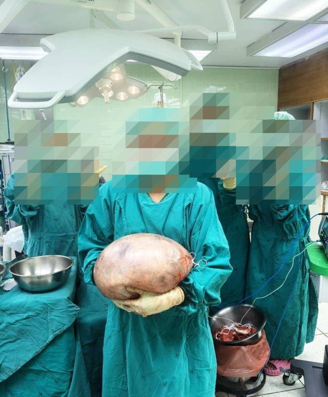 태국 의료진이 30대 여성 몸에서 제거한 난소 난종을 들고 있다. 채널7 페이스북 갈무리