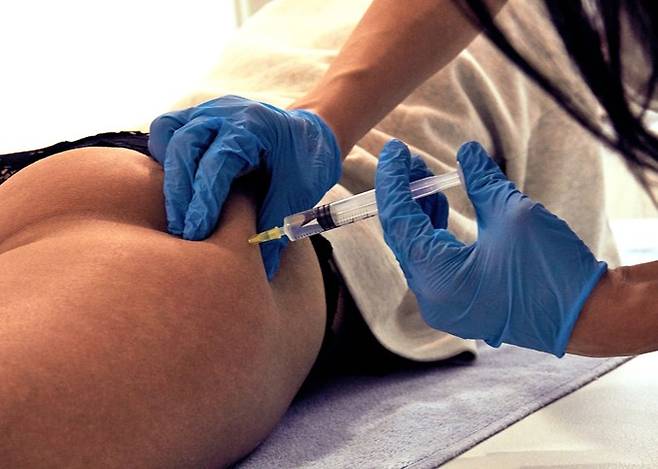 최근 영국에서 브라질리언 엉덩이 리프트(Brazilian Butt Lift, BBL) 시술을 받은 20대 여성이 전신성 패혈증에 빠져 생명을 위협받는 사례가 보고됐다. *사진은 이해를 돕기 위함이며 직접적 관련 없음. [사진=게티이미지뱅크]