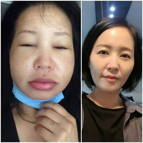 왼쪽부터 유전성 혈관부종 증상이 찾아온 민수진 씨의 모습과, 증상이 가라앉은 평상시 모습. 이마저도 증상이 그나마 가라앉았을 때의 모습이다. 그는 "눈을 아예 못 뜰 만큼 붓고, 입술·볼 등 피부가 늘어날 수 있을 만큼 다 늘어난다"고 말했다. /사진=민수진 씨 제공