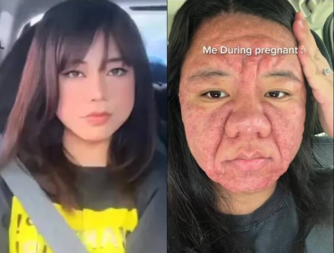말레이시아 출신의 파라 파이잘이라는 여성은 자신의 틱톡 계정에 임신 후 심해진 얼굴 변화로 인해 심한 정서적 스트레스를 받았다고 고백했다. [사진=파라 파이잘 틱톡]