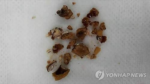요로결석 환자 몸에서 나온 결석 위 이미지는 자료 사진으로 기사와 직접 연관은 없습니다. [연합뉴스 자료사진]