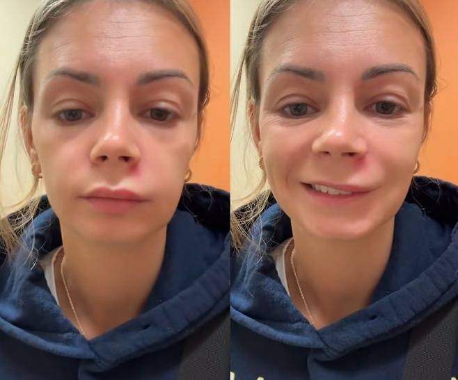 미국 여성 리시 마리가 콧구멍 바로 아래에 난 여드름을 짠 이후 한쪽 얼굴이 부어오른 탓에 웃는 표정을 지어도 한쪽 입꼬리만 올라가는 모습. 틱톡 캡처