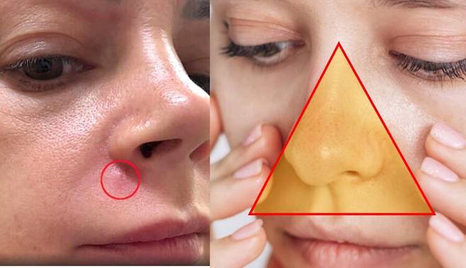 한 여성이 코 옆에 난 작은 여드름을 짜려다 병원까지 가야했던 사연을 공유하면서 이 부위 여드름 짜기에 주의를 기울여야 한다고 당부하고 나섰다. [왼쪽 사진=알리샤 모나코 틱토/ 오른쪽=게티이미지뱅크 편집]