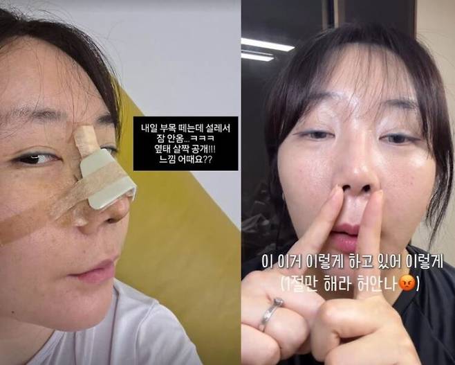 "허안나가 코 성형 부작용으로 재수술을 했다고 밝혔다. [사진=허안나 인스타그램]