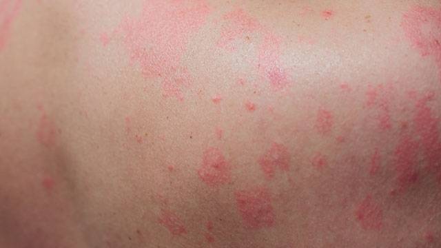 대상포진은 골든타임 내 치료받는 것이 중요하다｜출처: 게티이미지뱅크