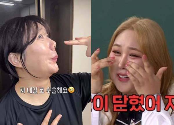전문가들은 코 성형의 재수술이 많은 이유로 코의 해부학적 특성, 보형물의 한계, 환자 요인 등​을 꼽는다./허안나 인스타그램, JTBC '아는 형님' 캡처​