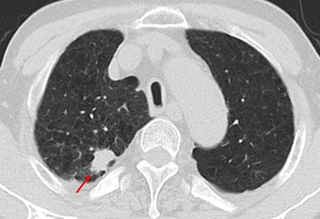 저선량 흉부 CT 검사에서 2.4cm 크기의 폐결절(붉은색 화살표)이 확인됐고, 추적 관찰 결과 폐암으로 진단됐다. [사진=한림대동탄성심병원]