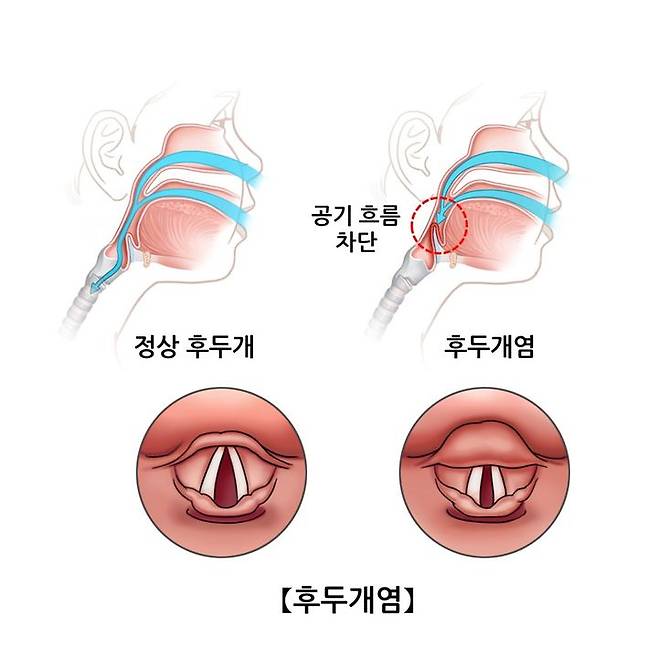 [뉴시스] 영국의 29세 남성이 편도염 오진 하루 만에 '후두개염'으로 인한 급성 기도 폐쇄로 사망했다. (사진 = 서울아산병원 누리집 캡처) 2025.08.19. *재판매 및 DB금지 *재판매 및 DB 금지
