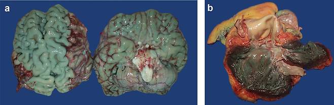 메틸렌 블루로 장기가 청록색으로 물든 모습. 뇌와 심장. 사진=Baumgarten/Forensic Science, Medicine and Pathology