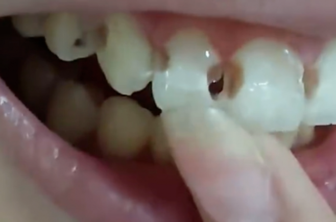5년간 치아 교정 치료를 받아 온 중국의 한 20세 여성이 구강 위생 관리가 제대로 이뤄지지 않아 치아 8개에 구멍이 뚫린 사연이 알려져 충격을 주고 있다. 웨이보