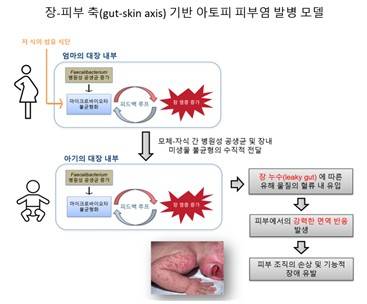 이번 연구에서 제시한 아토피 피부염 발병 모델