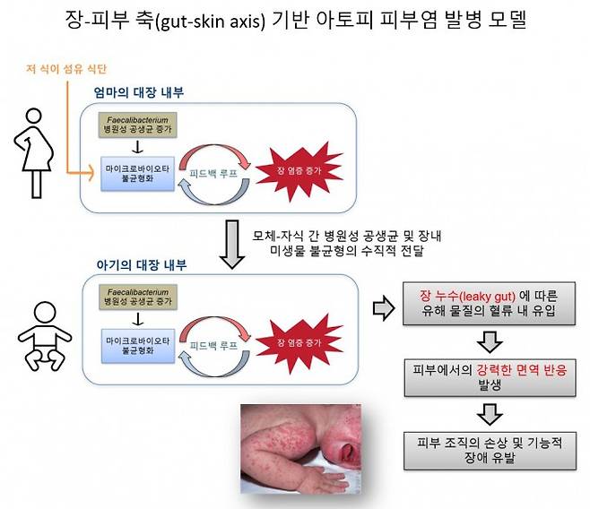 김희남 고려대 교수팀이 제시한 아토피 피부염 발병 모델. 장내미생물인 피칼리박테리움 병원성 공생균이 유익균보다 우세하고 모체 식이섬유 섭취가 부족한 경우 모체와 자손 모두에서 전신 염증이 증가했다. 자손의 과도한 면역 반응으로 피부 조직 손상이 유발돼 아토피 피부염으로 이어질 수 있다. 김희남 고려대 교수 제공