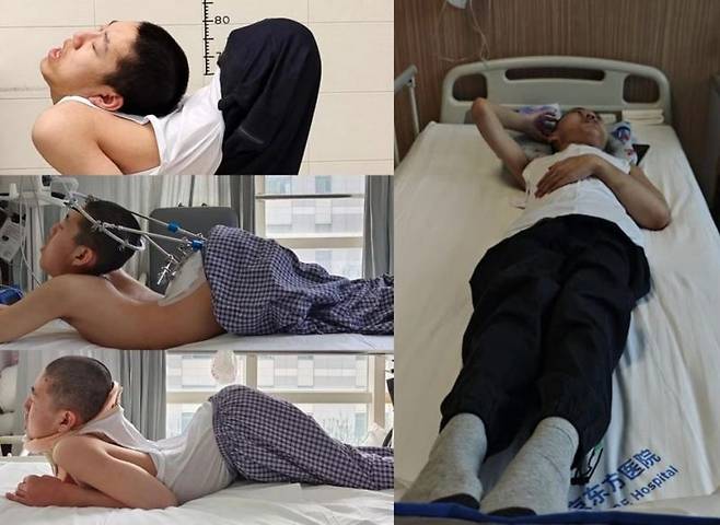 4차례에 걸친 수술로 조금씩 굳었던 허리가 펴진 모습(왼쪽)과 마지막 수술을 마친 뒤 똑바로 누울 수 있게 된 장옌천의 모습 /사진=SCMP 갈무리