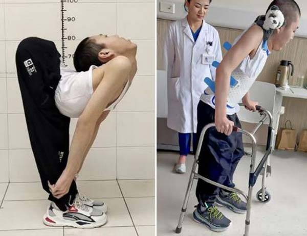 허리가 거의 180도로 꺾여 ‘폴더 소년’으로 불렸던 중국 청년 장옌천이 드디어 똑바로 서는 데 성공했다./사진=SCMP 캡처
