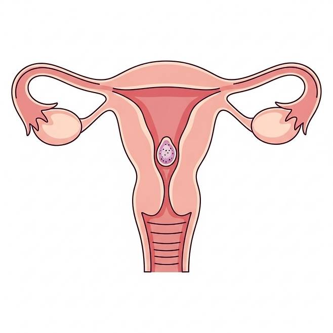 자궁내막암 [자료 이미지]