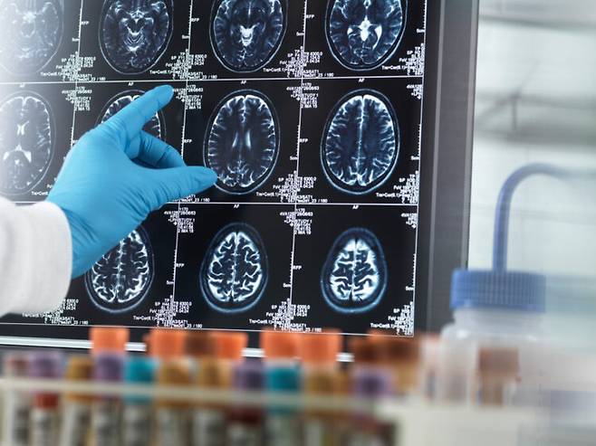 뇌 MRI 영상으로 근감소증 진행 정도를 측정하는 기법이 나왔다. [사진=클립아트코리아]