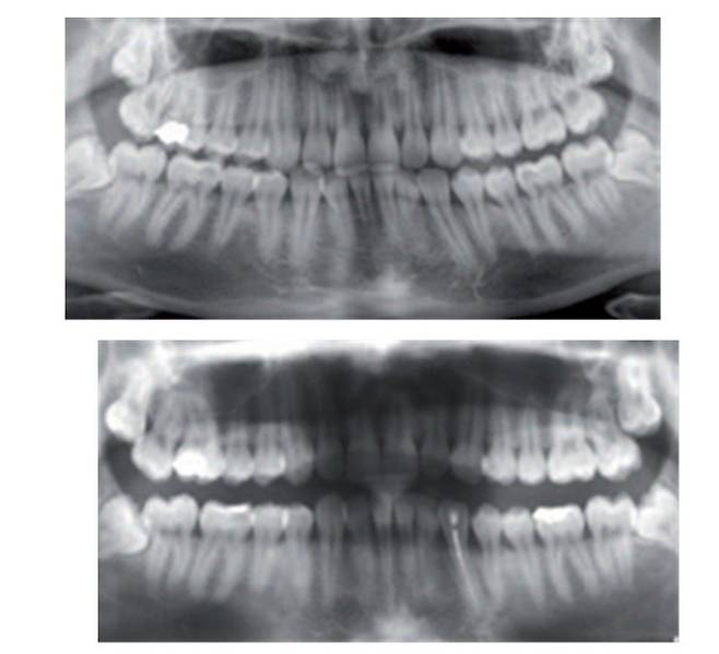 셀프 치아 장치로 인해 '교합 변화' 부작용 발생 사례(위는 장착 전, 아래는 장착 후 치아 X선 사진).