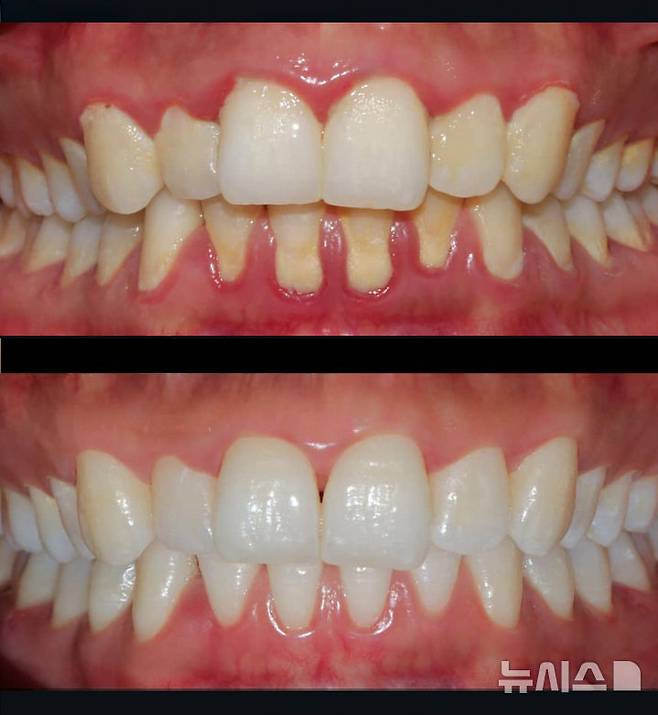 [서울=뉴시스] (위아래순) 치주질환 치료 전후 사진. (사진= 고대안산병원 제공)