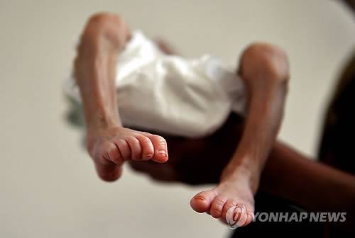 영양실조에 걸린 아기 [EPA=연합뉴스]