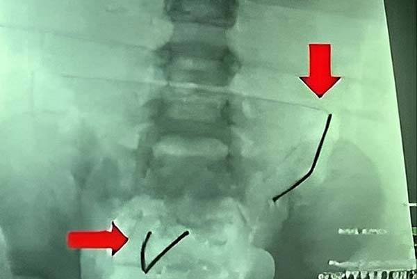 베트남에서 5세 남아가 장난감 자석을 사켜 소장에 8개의 구멍이 생겼다. CT사진 중 검은색은 장기 내부에 달라붙은 자석 중 일부 모습./사진=VN 익스프레스 캡처