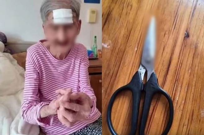 중국 상하이에서 98세 여성이 이마에 난 뿔 모양의 종양을 스스로 잘라내다 대량 출혈로 긴급 수술을 받는 사건이 발생했다. [사진=SNS]