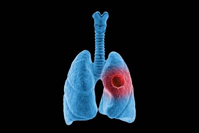 미국 브리스톨마이어스스퀴브가 개발 중인 표적 항체-약물접합체(ADC) 신약 이자-브렌(iza-bren)이 단독·병용 요법 모두에서 유의미한 치료 효과를 나타냈다. 폐암을 나타낸 이미지.&nbsp;게티이미지뱅크 제공.