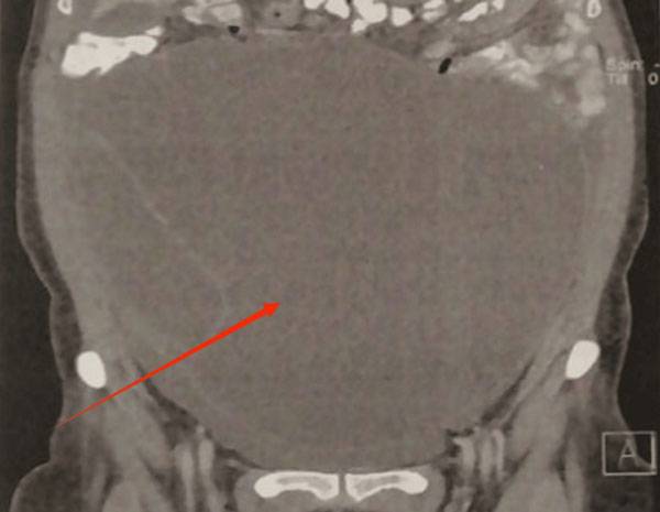 거대 경계성 난소 종양 환자의 복부 MRI 촬영 사진. 종양이 배 안을 꽉 채우고 있는 것이 보인다(빨간 화살표가 가리키는 부분)./사진=큐레우스