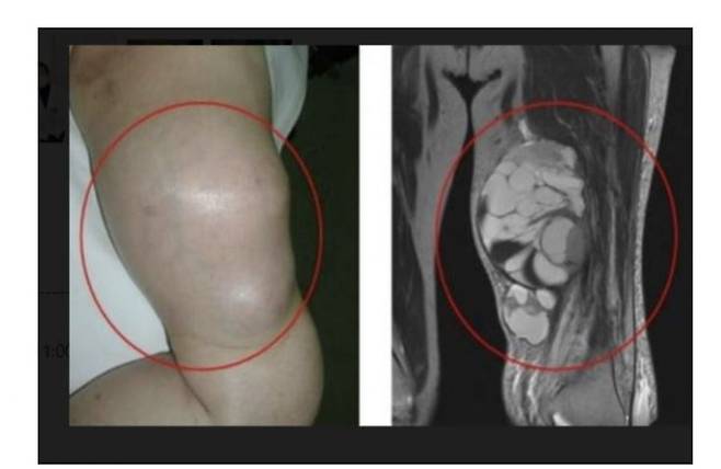 허벅지에 생긴 연부 조직 육종. 국민일보DB