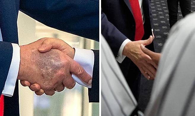 (좌) 지난달 한미 정상회담 당시 트럼프 미국 대통령의 손등, (우) 11일 뉴욕 양키스 선수들과 악수하는 트럼프 대통령의 손등 [사진 출처 = X]