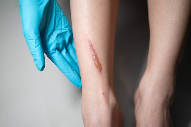 화상으로 인한 피부 손상은 피부 최상층인 표피의 얇은 층을 이식하는 방식으로 치료하는 경우가 많다. 하지만 표피는 기본적으로 단일 세포로 구성돼 있어 표피만 이식하면 심각한 흉터가 남는다. [사진= 게티이미지뱅크]