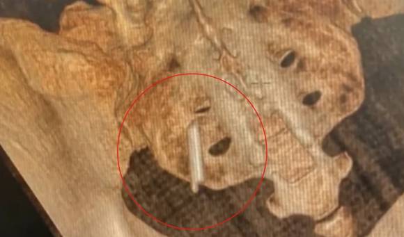 다행히 후 씨는 수술을 받고 이물질을 꺼내는 데 성공했다고 한다. 사진은 해당 여성의 엑스레이. [사진=바이두 갈무리 ]