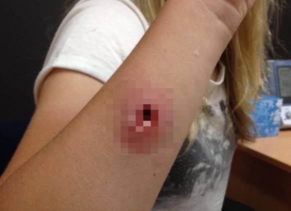 일본 오사카에서 열리고 있는 '2025 오사카·간사이 엑스포'가 맹독성 외래종 거미 출현으로 비상이다. 사진은 붉은등과부거미에 물린 상처 부위로, 오사카 엑스포와는 무관. [사진=yanchepnews]