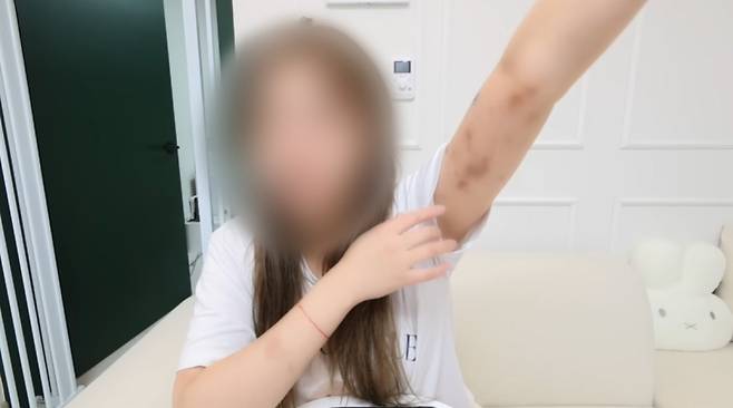 ▲ 폭행당해 멍든 신체를 공개하는 대만 유튜버 [B씨 SNS]&nbsp;&nbsp;