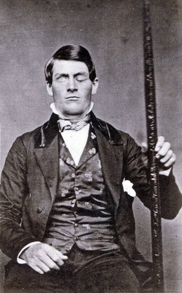 자신의 뇌를 망가뜨린 쇠막대기를 들고 앉은 피니어스 게이지.