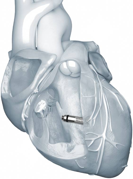 마이크라가 심장 내부에 삽입된 모습. 별도의 배터리나 전극선 없이 심장 박동을 조율한다. /메드트로닉 제공