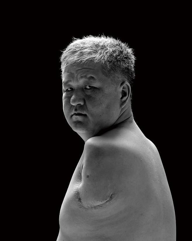 중증화상 산재로 양팔을 절단한 몽골 출신 이주노동자 오기나. 김진수 선임기자