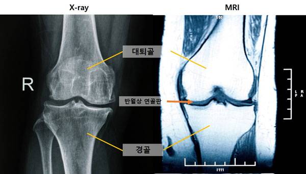 왼쪽부터 엑스레이로 찍은 무릎, MRI로 찍은 무릎./사진=게티이미지뱅크