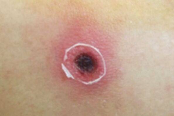 쯔쯔가무시균을 보유한 털진드기 유충에 물린 자리에 생긴 검은 딱지(가피). 질병관리청 제공