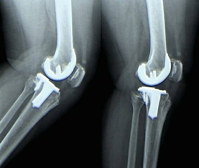 인공관절 이미지 (출처=클립아트코리아)