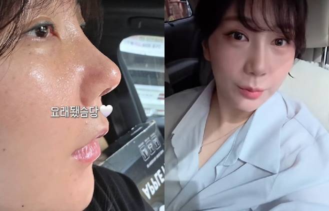 허안나가 코 재수술 후 물오른 비주얼을 자랑했다. 허안나 SNS 캡처