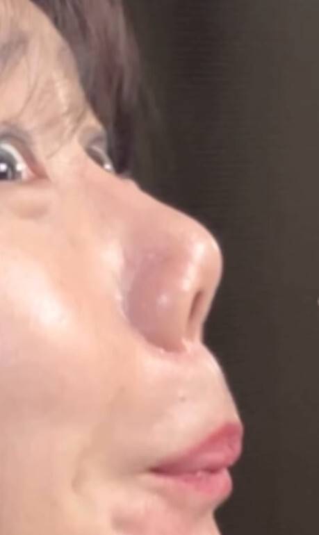 허안나는 오랜 시간 재수술을 고민했음을 밝혔다. 허안나 SNS 캡처