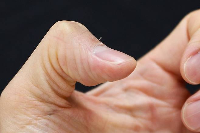 [서울=뉴시스] 15일 의료계에 따르면 생인손이라고도 불리는 조갑주위염은 손톱, 발톱 주변이 붓고 염증이 생기는 질환을 말한다. (사진=고대안산병원 제공) 2025.08.14. photo@newsis.com *재판매 및 DB 금지 /사진=뉴시스