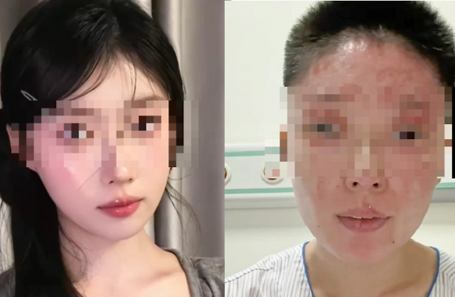 가스 폭발 사고로 얼굴에 화상을 입은 27세 모델 겸 메이크업 아티스트가 온라인에서 회복 경험을 공유하는 인플루언서로 변신해 눈길을 끌었다. [사진출처 = SCMP]